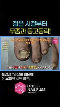 젋은 시절부터 무좀과 동고동락! 😎 #내성발톱 #toenails #ingrown_toenail #발톱무좀 #무좀 #무좀발톱 #족보있는그녀들