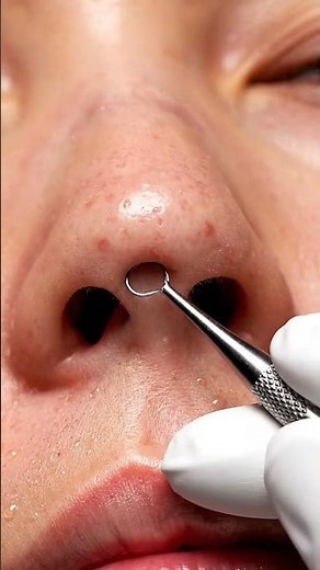 “Under Nose Blackhead Removal 😮 | Super Satisfying ASMR Pops”