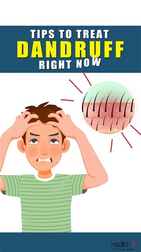 Tips to Treat Dandruff Right Now #health #fitness #dandruff #wellness | Health