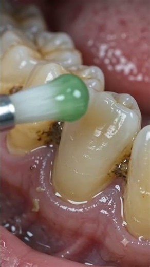 Teeth Cleaning transformation #dentalcleaning #teethdecay #satisfying