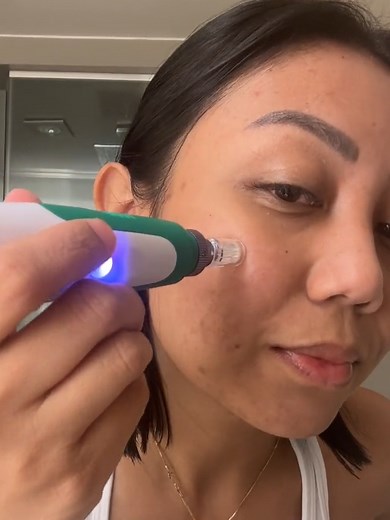 Derma Roller Philippines on TikTok