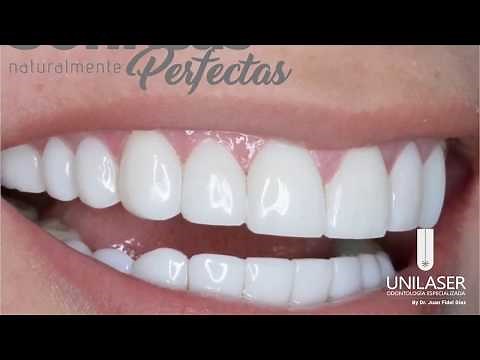 Unilaser | Diseño en Resina de Alta Estética