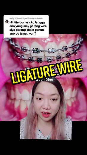 Tooth Coloured Ligature Wire - Wire Braces Recommendations