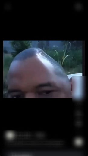 Dr Arun L Naik MCh | Decompressive craniectomy is a life-saving neurosurgical procedure performed when the brain swells dangerously after severe head injury,... | Instagram