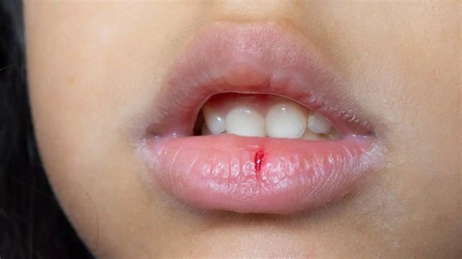 How to heal dry and chapped lips naturally: Signs, causes, and effective remedies