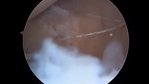 Arthroscopic Modified McLaughlin Procedure in Lateral Decubitus Position