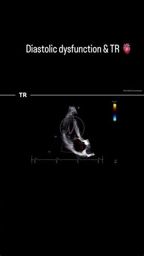 #TR & #sPAP in #echocardiography as a crucial measurement in #DD