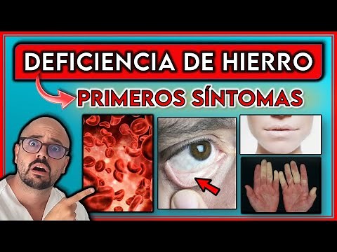 These are the first symptoms of iron deficiency || How do you know if you have low iron?