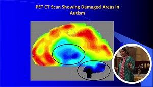 PET CT: Newer brain imaging for Autism | NeuroGen Brain and Spine Institute