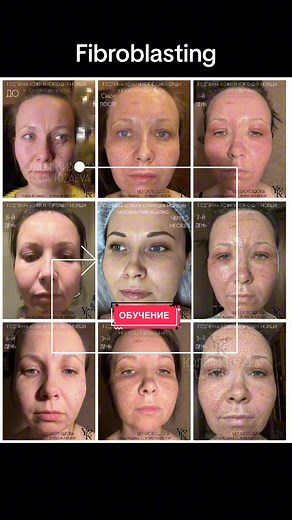 Fibroblast Lift Training for Facial Rejuvenation in Moscow