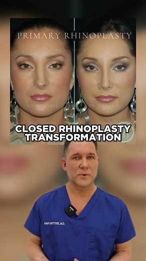 This patient underwent a closed rhinoplasty with me. Here are the details of her procedure 👆🏻 Info@DrMotykie.com for pricing and consult information. #ScarlessRhinoplasty #ClosedRhinoplasty #RhinoplastySurgeon #RhinoplastySurgery #NoseJob #NoseJobBeforeAndAfter #NoseJobSurgery #PlasticSurgeonSearch #PlasticSurgeonExplains #PlasticSurgeryTransformation #BoardCertifiedPlasticSurgeon #RhinoplastyResults #RhinoplastyResult #NoseSurgery #Rhinoplastik #RhinoplastikBeforeAndAfter #CosmeticSurgery #Fa