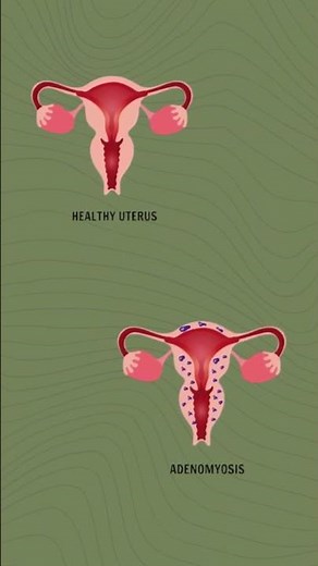 Endometriosis vs. Adenomyosis