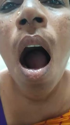 Tongue dyskinesia