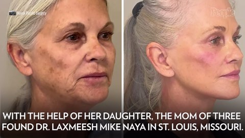 Woman, 66, Gets 9 Cosmetic Procedures During 6-Hour Plastic Surgery. Her Transformation Is Jaw-Dropping (Exclusive)