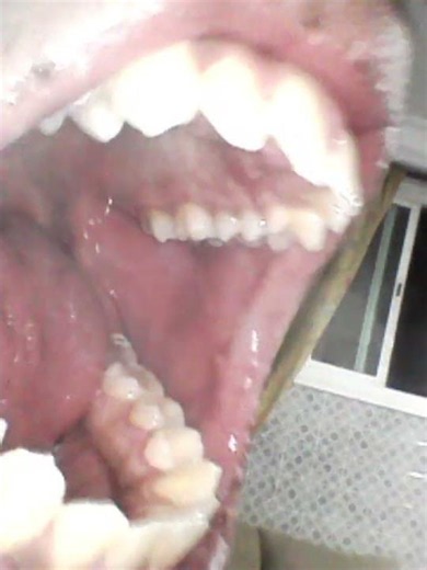 Inside my cousin's mouth