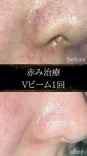 鼻周りの赤み治療法のご紹介
