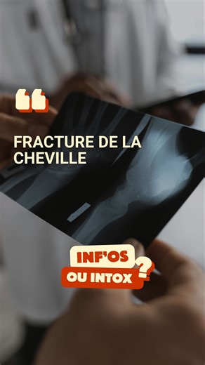 Docteur Bruno Lévy | Chirurgien Orthopédiste on Instagram: "Fracture de la cheville La cheville est une articulation complexe : tibia, péroné et talus travaillent ensemble pour assurer stabilité et mouvement. Fracture simple et sans déplacement : plâtre ou botte pendant 6 semaines + rééducation pour éviter l’enraidissement. Fracture déplacée ou instable : chirurgie avec vis ou plaques, consolidation en 3 mois, récupération sportive jusqu’à 6 mois. Causes fréquentes : torsion en sport, chute, ac