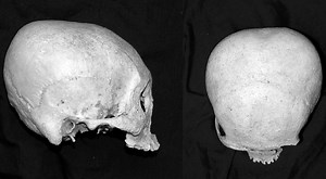 The Precolonial Visayan Practice of Skull Deformation