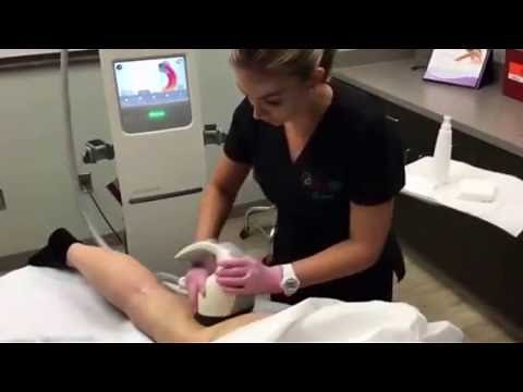 VelaShape 111. What to expect.