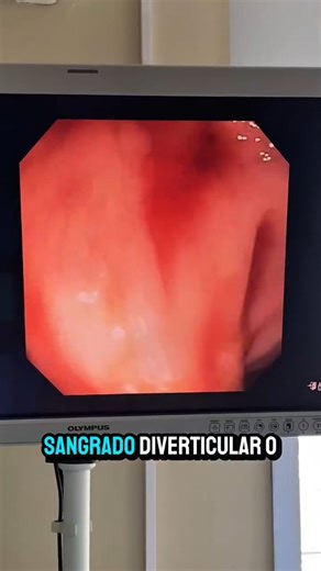 Dr Juan Garcete | “Sangrado digestivo bajo no es todo lo mismo. 👉 Dolor abdominal previo + sangrado rectal en adultos mayores o con factores de riesgo... | Instagram