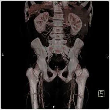 Vascular: Runoff study: 3D reconstructions demonstrate vascular map(1 of 2)