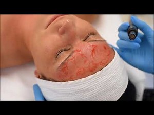 DERMAPEN® - jak wygląda zabieg?