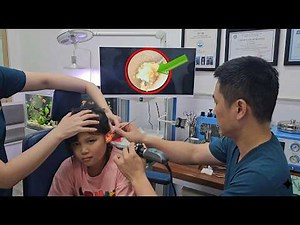 子どもの耳掃除で大量の耳あか除去！見ていて気持ちいいASMR耳ケア EP.5