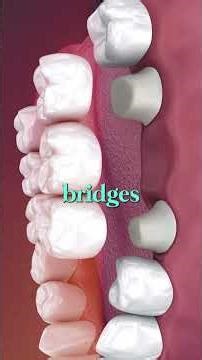 Pain-Free Dental Experience | Digital Dental Scanning Benefits #shorts