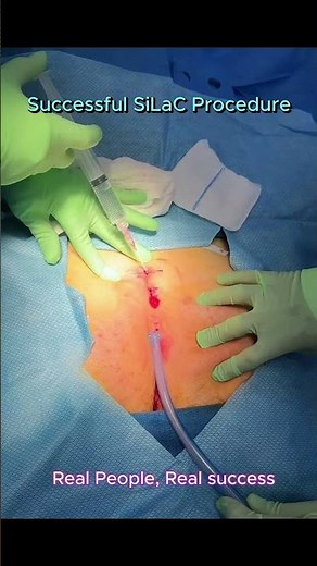 Pilonidal Cyst Laser Treatment with SiLaC: Fast Relief, Less Pain, Minimal Scarring