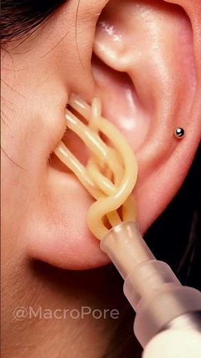 Extreme Ear Blackhead Removal #ASMR #Vacuum #macroasmr