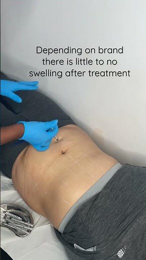 Lose Belly Fat | Fat Dissolving Injections