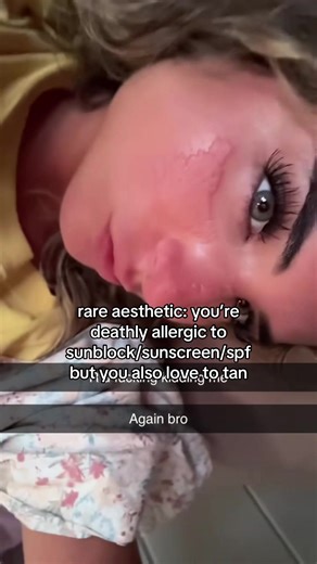 yall be glad ur not allergic #fyp #summer #sunburn #funny #rareaesthetic