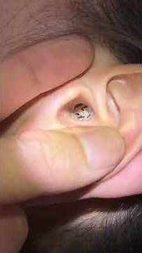 耳垢の大きさにビックリ！耳の健康管理法