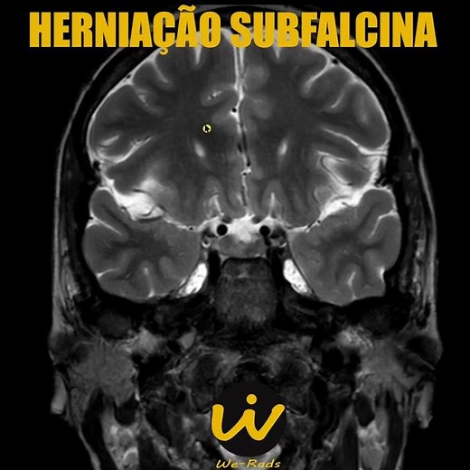 Explicando Herniação Subfalcina #Shorts