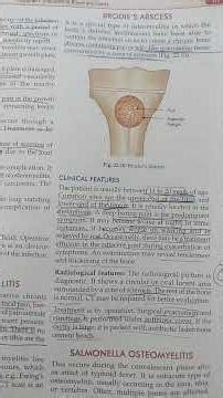 Brodie's Abscess made simpler in form of song