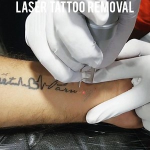11 reactions | Get your unwanted tattoo removed now. . Call 11 am to...