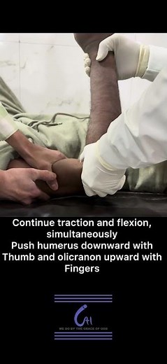 Elbow Dislocation Reduction