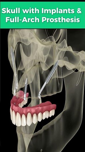 How does a dental implant integrate with the skull's jawbone?