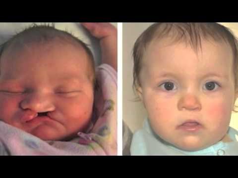 Cleft Lip, Cleft Palate: Before and after pictures