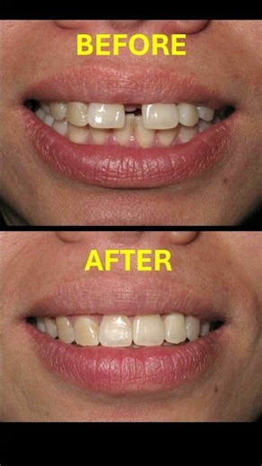 Braces can change smiles! Teeth Gap & Diastema #braces #orthodontist