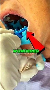 alginate impression #media #shortvideo