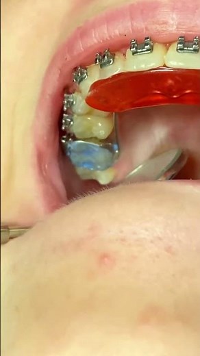 Bite Plate Braces - Orthodontic Treatment Deep Bite - Toothtime Family Dentistry New Braunfels