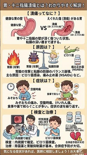 【胃の痛み】みぞおちが痛む「胃・十二指腸潰瘍」の正体とは？ピロリ菌・痛み止めが招くバランス崩壊と、最新の検査・治療法を徹底解説