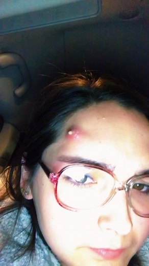 Dealing with a Painful Carbuncle: My Experience