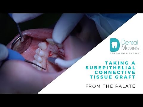 Taking a subepithelial connective tissue graft from the palate. 🦷