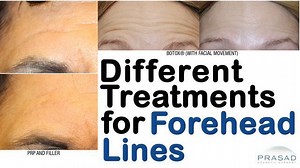 Causes of Forehead Lines, and Surgical and Non-Surgical Treatments