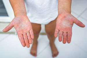 Irritated Skin from Latex Contact? Find Out If It’s an Allergy or Sensitivity