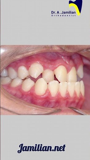 Fixing a Narrow Upper Jaw Without Surgery | Modern Orthodontic Treatment Explained #orthodontics