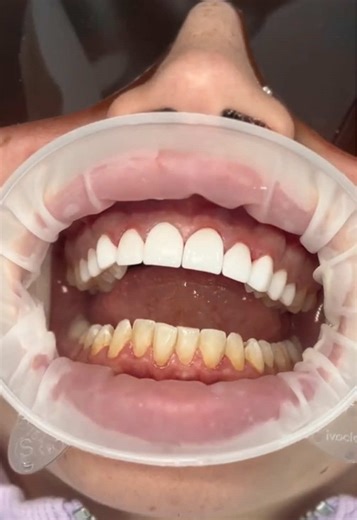 This is the moment we preview the smile ✨ Porcelain veneer try-on to assess fit, shape, and aesthetics before final placement. This video is for general information only and does not replace professional dental advice. Individual results vary. Please consult an AHPRA-registered dental practitioner for personalised advice. Please note results shown are specific to this patient and will vary for each individual. Dr Joseph William Alphonse (DENO001939837) - Registered Dentist , General Registration