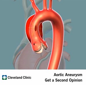 4.1M views · 6.2K reactions | The aorta is under more stress than any other organ in the body and in some people that stress can cause degeneration. Know your options when it comes to prevention, maintenance and treatment options for aortic aneurysm. | Cleveland Clinic | Facebook